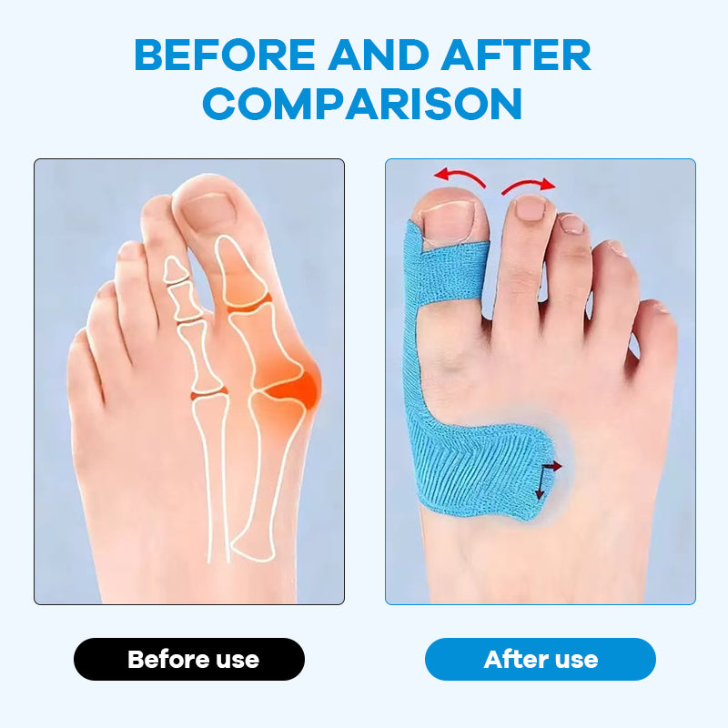 Előre kivágott hallux valgus korrekciós kineziológiai tapasz