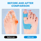 Előre kivágott hallux valgus korrekciós kineziológiai tapasz